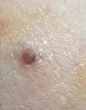 医生看了一眼这个“痣”，就说是肝癌信号?这25种痣也是...(图25)