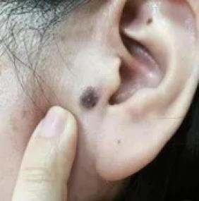 医生看了一眼这个“痣”，就说是肝癌信号?这25种痣也是...(图9)