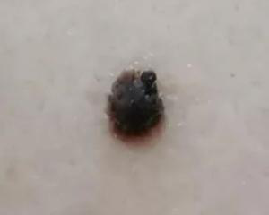 医生看了一眼这个“痣”，就说是肝癌信号?这25种痣也是...(图12)