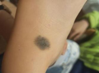 医生看了一眼这个“痣”，就说是肝癌信号?这25种痣也是...(图2)