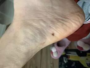 医生看了一眼这个“痣”，就说是肝癌信号?这25种痣也是...(图23)