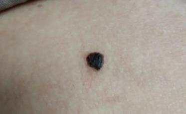 医生看了一眼这个“痣”，就说是肝癌信号?这25种痣也是...(图4)