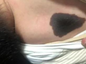 医生看了一眼这个“痣”，就说是肝癌信号?这25种痣也是...(图13)