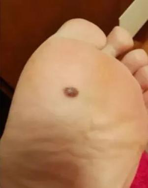 医生看了一眼这个“痣”，就说是肝癌信号?这25种痣也是...(图14)