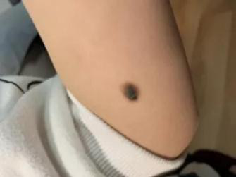 医生看了一眼这个“痣”，就说是肝癌信号?这25种痣也是...(图16)