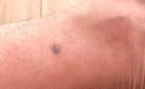 医生看了一眼这个“痣”，就说是肝癌信号?这25种痣也是...(图17)