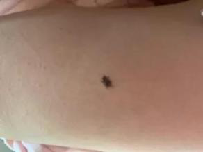 医生看了一眼这个“痣”，就说是肝癌信号?这25种痣也是...(图24)