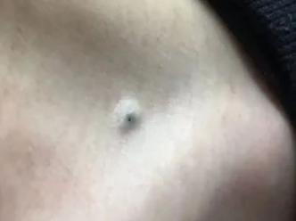 医生看了一眼这个“痣”，就说是肝癌信号?这25种痣也是...(图10)