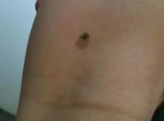 医生看了一眼这个“痣”，就说是肝癌信号?这25种痣也是...(图15)