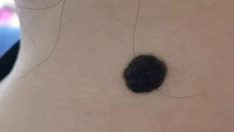 医生看了一眼这个“痣”，就说是肝癌信号?这25种痣也是...(图21)