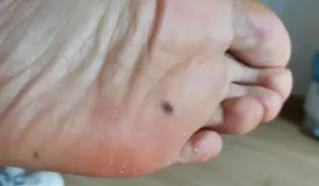 医生看了一眼这个“痣”，就说是肝癌信号?这25种痣也是...(图26)