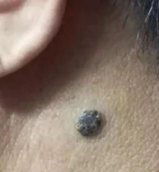 医生看了一眼这个“痣”，就说是肝癌信号?这25种痣也是...(图8)