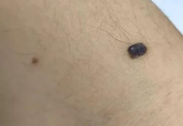 医生看了一眼这个“痣”，就说是肝癌信号?这25种痣也是...(图7)
