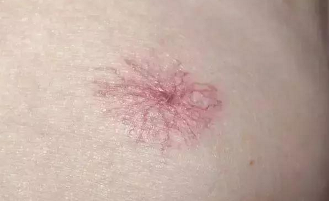 医生看了一眼这个“痣”，就说是肝癌信号?这25种痣也是...(图1)