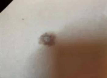 医生看了一眼这个“痣”，就说是肝癌信号?这25种痣也是...(图5)