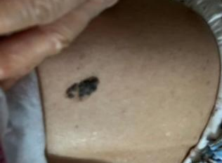 医生看了一眼这个“痣”，就说是肝癌信号?这25种痣也是...(图3)