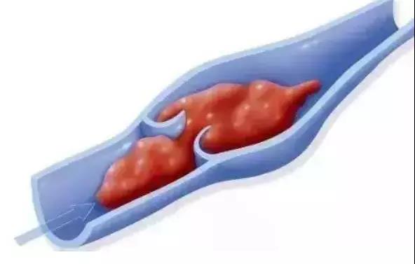 【关注】肿瘤晚期患者为何会出现下肢水肿?如何应对?(图2)