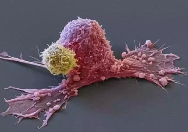 【肿瘤科普】人人都有肿瘤细胞，为什么不是人人都患肿瘤?(图3)