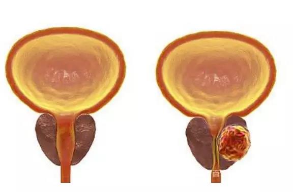 前列腺增生别忽视，治疗不当或变为前列腺肿瘤，几个...(图2)