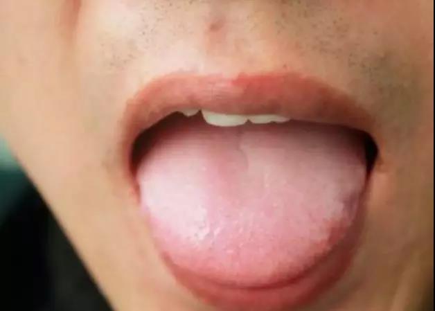 看舌头知百病，还能预示肿瘤前病变!有这两种舌象的人...(图1)