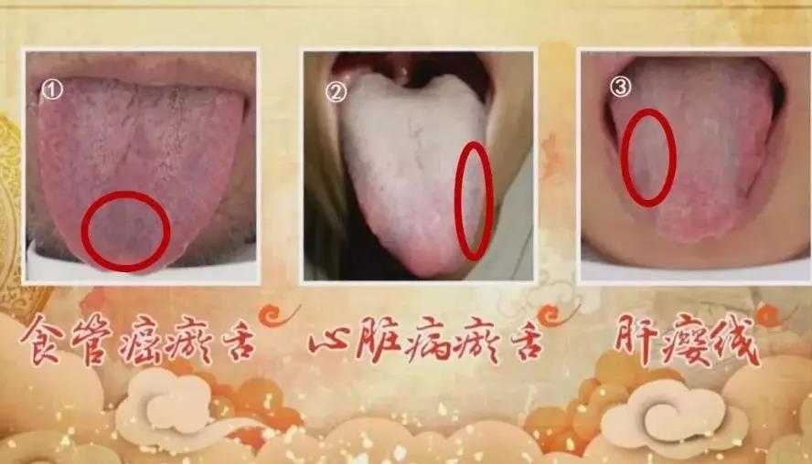 看舌头知百病，还能预示肿瘤前病变!有这两种舌象的人...(图4)