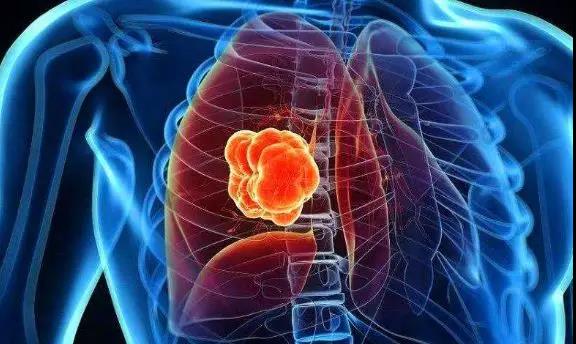 【揭秘】不抽烟、不喝酒、没遗传，为什么得恶性肿瘤的....(图4)