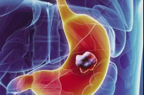 【揭秘】不抽烟、不喝酒、没遗传，为什么得恶性肿瘤的....(图3)