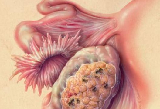 【关注】不生孩子易患肿瘤 ,盘点让你得肿瘤的几大因素(图2)