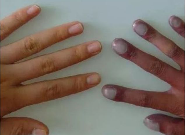 【关注】体内有“肿瘤”，手脚先知!医生提醒：手脚...(图5)