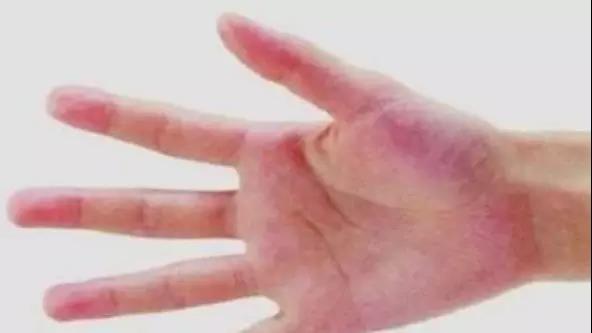 【关注】体内有“肿瘤”，手脚先知!医生提醒：手脚...(图4)