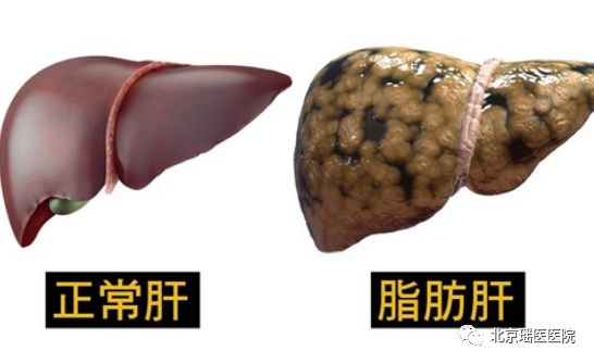 【健康科普】瘦子也会得脂肪肝，后果比胖子更严重！(图2)