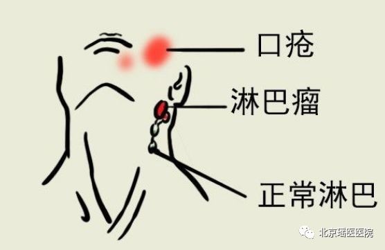 【专家提醒】反复口腔溃疡别大意，当心淋巴瘤(图2)