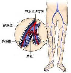 静脉曲张的危害您了解多少(图1)