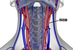 颈动脉狭窄，脑梗的罪魁祸首！瑶医内服加外用，专业清理..(图2)