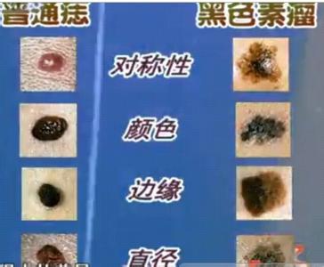 瑶医专家讲解：黑色素瘤该如何护理(图1)
