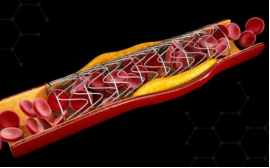 颈动脉狭窄，脑梗的罪魁祸首！瑶医内服加外用，专业清理..(图3)