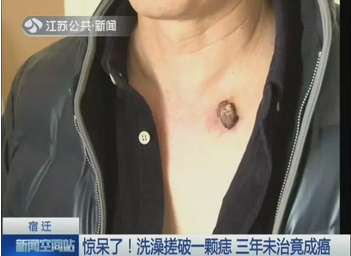 洗澡搓破痣竟成癌!身上有这六种痣的要当心了!(图2)