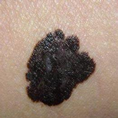 黑痣刺痒、长大、溃烂 警惕恶变成癌症(图1)