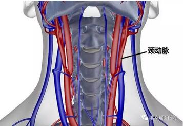 人过三十五，就怕血管堵，颈动脉狭窄年轻化，不容小觑(图2)