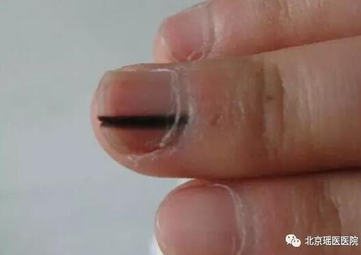 指甲上也能反映出的肿瘤信号，只是被很多人忽视了(图8)