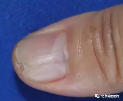 指甲上也能反映出的肿瘤信号，只是被很多人忽视了(图5)