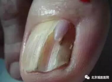 指甲上也能反映出的肿瘤信号，只是被很多人忽视了(图7)