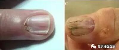 指甲上也能反映出的肿瘤信号，只是被很多人忽视了(图6)