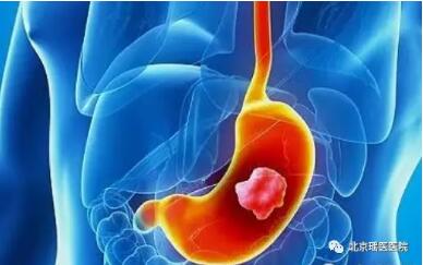 【肿瘤科普】身体上什么样的肿块可能是恶性肿瘤?(图2)