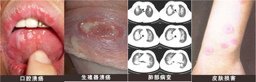 引发白塞病的并发症有哪些(图1)