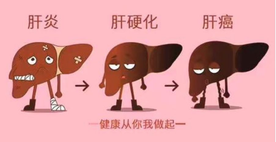 乙肝恶化有征兆!4个症状持续出现，是肝肿瘤的“苗头”(图1)