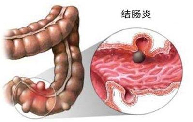 炎症距离肿瘤有多远? 警惕炎症可能成为肿瘤“帮凶”(图3)
