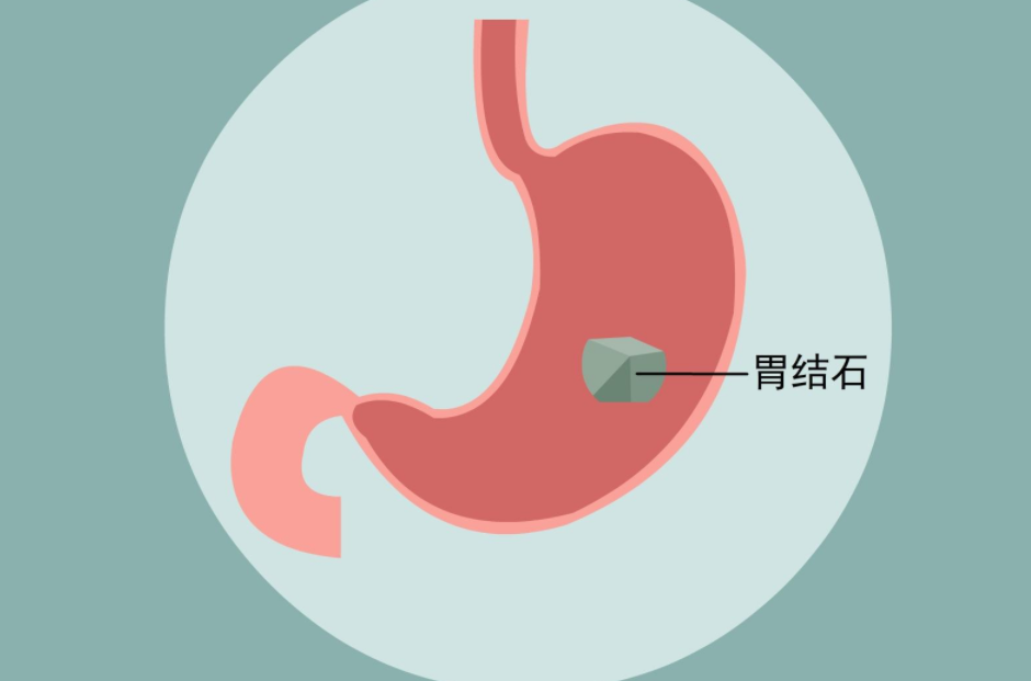 结石很常见，却增加13倍肿瘤发病率!(图2)