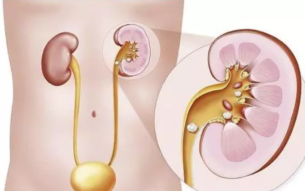 结石很常见，却增加13倍肿瘤发病率!(图3)