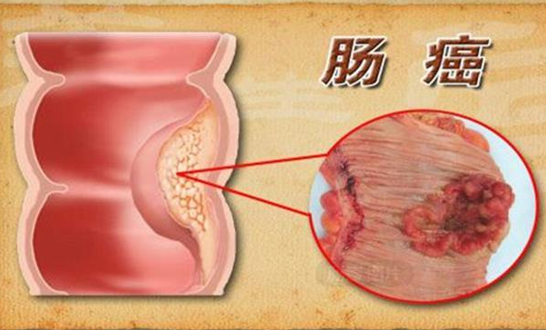 癌症来之前，都会经历癌前病变！可惜很多人没重视(图4)